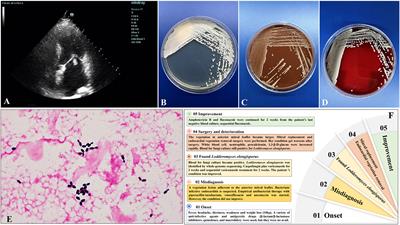 Subacute infective endocarditis due to Lodderomyces elongisporus: a case report and review of the literature